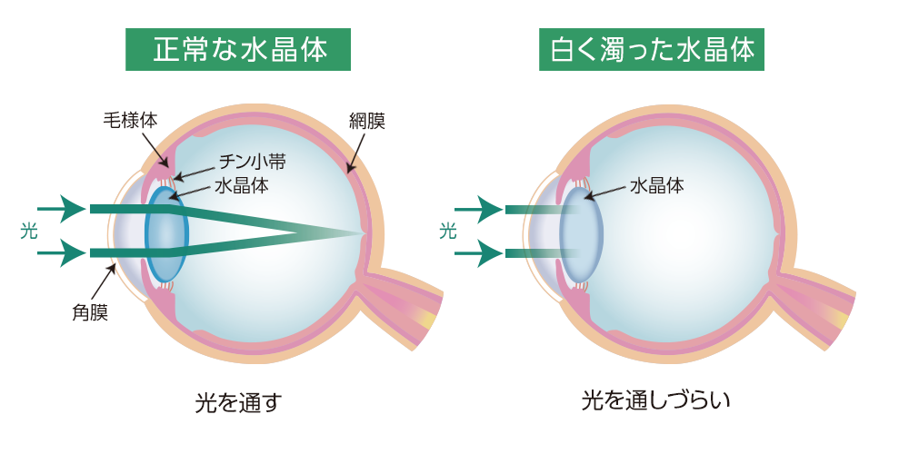 正常角膜 円錐角膜によって突出した角膜