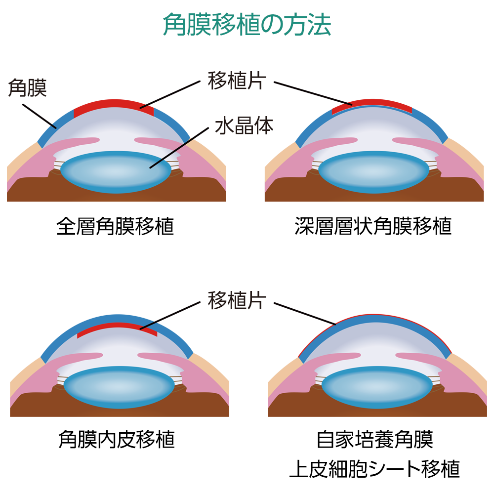 角膜移植の種類