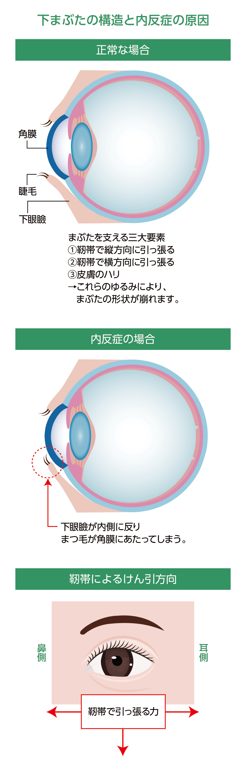後天性眼瞼内反症