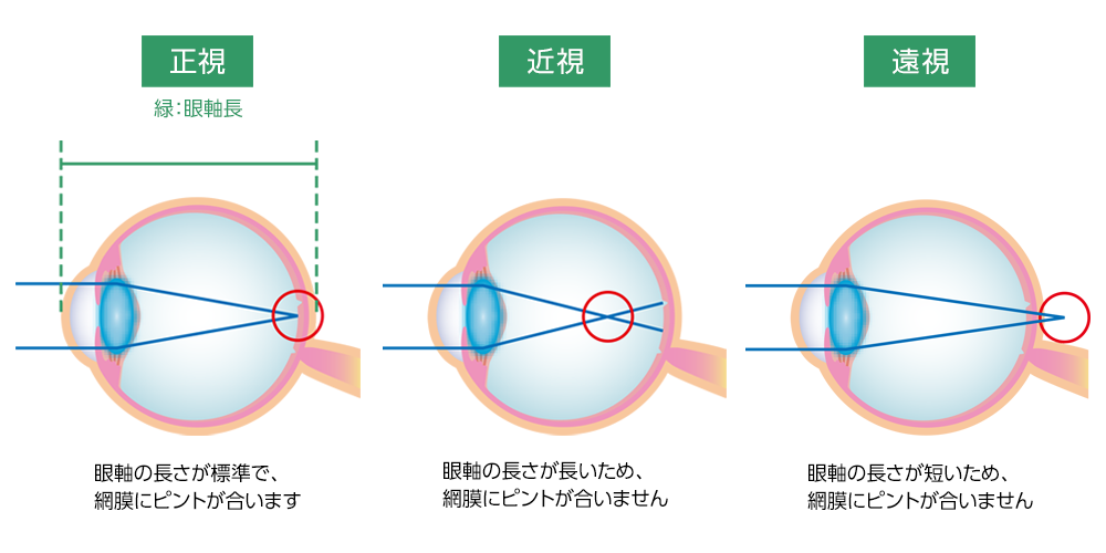 角膜剥離を防ぐにはどうすればよいですか?
