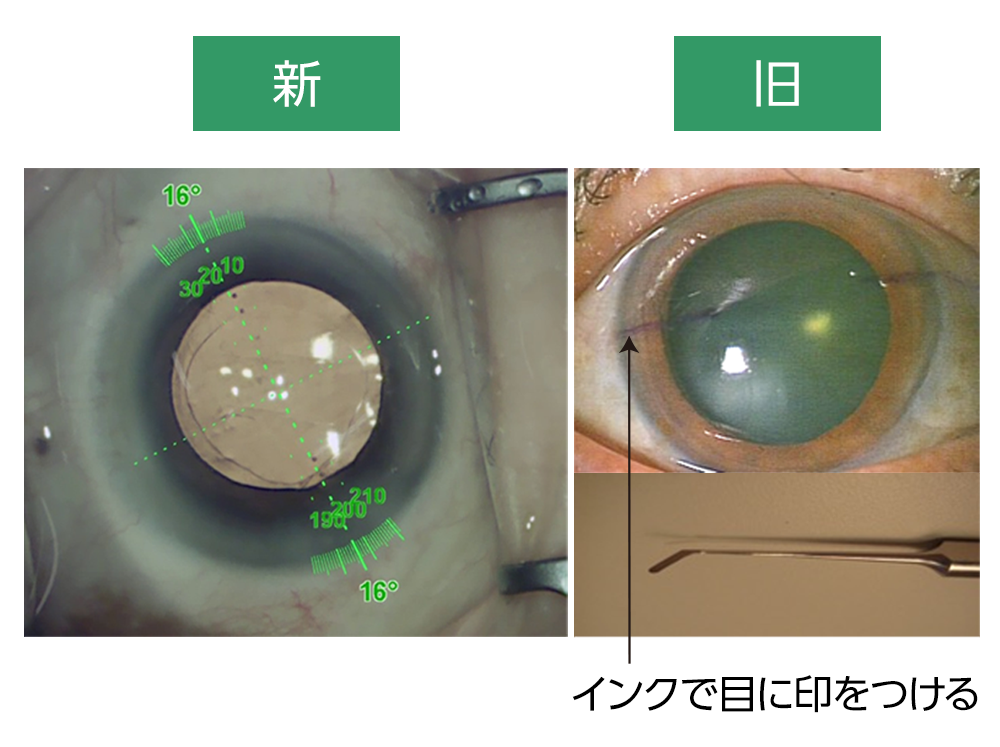 トトーリック眼内レンズを用いた白内障手術を正確に行うためのシステム